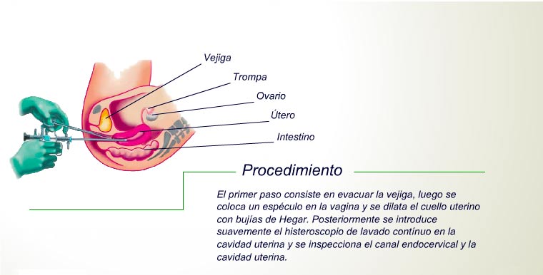 Histeroscopía