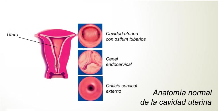 Histeroscopía