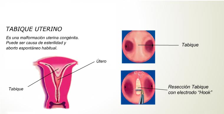 Histeroscopía