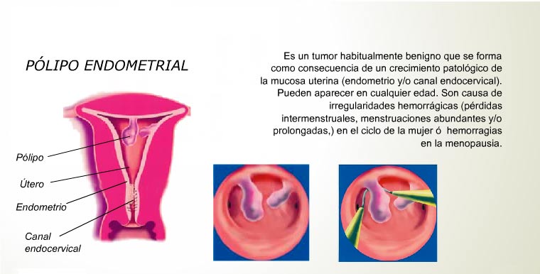 Histeroscopía