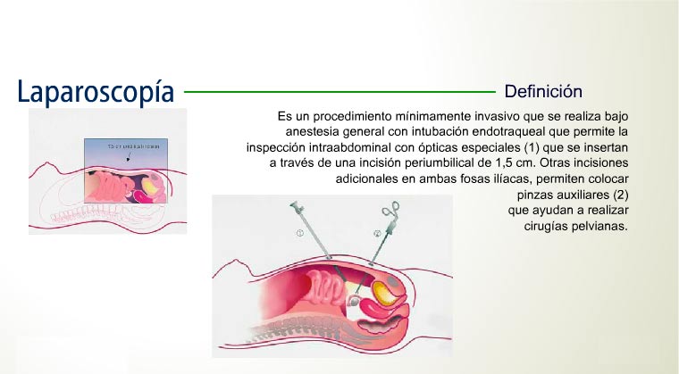 Laparoscopía