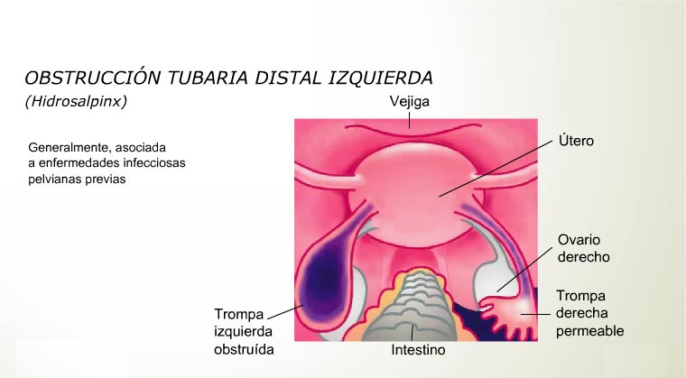 Laparoscopía