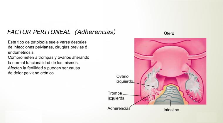 Laparoscopía