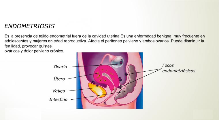 Laparoscopía